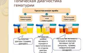 Что такое гематурия — чем опасный симптом для организма