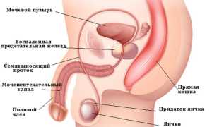 Симптомы простатита