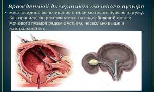 Дивертикул мочевого пузыря — чем опасно заболевание для мужского здоровья