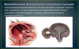 Дивертикул мочевого пузыря — чем опасно заболевание для мужского здоровья