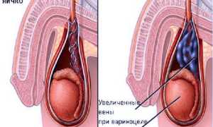 Варикоцеле, лечение народными средствами